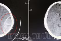 Hôn mê do chủ quan chấn thương vùng đầu không đi khám