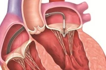  Thay van tim có nguy hiểm không? 