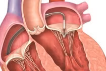  Thay van tim có nguy hiểm không? 