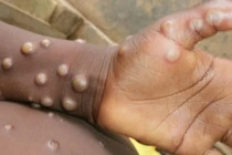 Lo ngại đại dịch virus đậu mùa khỉ bùng phát sau COVID-19