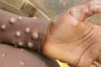 Lo ngại đại dịch virus đậu mùa khỉ bùng phát sau COVID-19