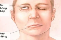 Liệt mặt vì thích ngủ nơi gió lùa