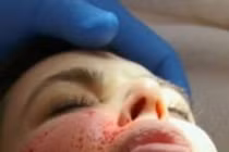 Nhiễm khuẩn da vì làm đẹp bằng máu tự thân