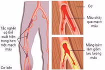Can thiệp động mạch chậu – chi dưới qua da bằng ống thông