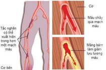 Can thiệp động mạch chậu – chi dưới qua da bằng ống thông