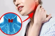 5 triệu chứng bệnh cường giáp bạn không thể bỏ qua