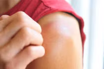 Dấu hiệu khi bị cháy nắng