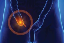 Mẹ nhầm đau ruột thừa với bụng kinh, con suýt mất mạng