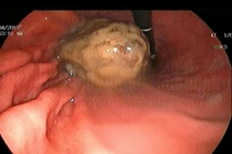 Đọng u bã thức ăn vì chăm ăn nghệ