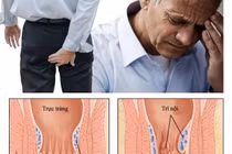  Phòng ngừa bệnh trĩ ở người già 