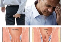  Phòng ngừa bệnh trĩ ở người già 