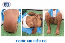 Cẩn thận với hội chứng Stevens - Johnson vì thuốc