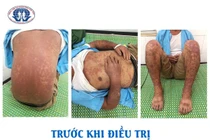 Cẩn thận với hội chứng Stevens - Johnson vì thuốc