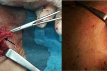 Ruột thừa viêm hoại tử chui vào khối thoát vị đùi