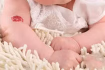 Bớt đỏ phải khám cẩn thận trước điều trị