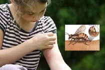 Làm dịu vết côn trùng đốt từ nước súc miệng