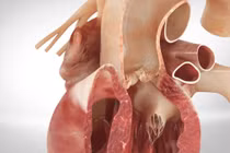 Tăng huyết áp gây lóc tách động mạch chủ