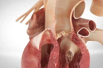 Tăng huyết áp gây lóc tách động mạch chủ