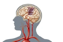 Những di chứng thường gặp của tai biến mạch máu não