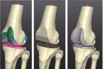 Sử dụng công nghệ in 3D để đổi mới vật liệu hợp kim y tế