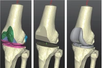 Sử dụng công nghệ in 3D để đổi mới vật liệu hợp kim y tế