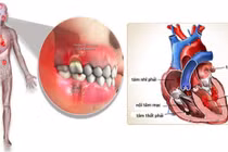 Viêm nội tâm mạc nhiễm khuẩn