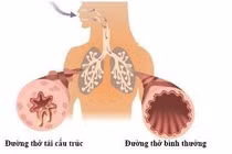 Ho lâu ngày không khỏi: hãy dùng Bảo Phế Vương