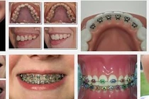 Chỉnh răng dễ gây biến dạng mặt?