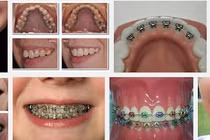 Chỉnh răng dễ gây biến dạng mặt?