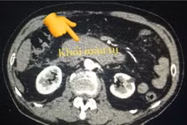 Máu tụ ổ bụng vì để cháu nhảy trên bụng 