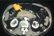 Máu tụ ổ bụng vì để cháu nhảy trên bụng 