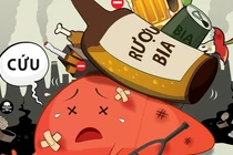 Uống rượu hay uống bia thì đều có nguy cơ mắc các bệnh ung thư dưới đây