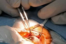 Chăm sóc mắt sau mổ đục thủy tinh thể