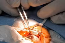 Chăm sóc mắt sau mổ đục thủy tinh thể