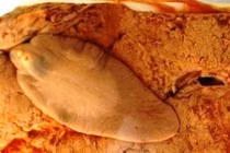 Thích ăn gỏi cá coi chừng sán lá gan