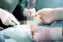 Ung thư dương vật biểu hiện giống bệnh hoa liễu