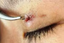 U hạt nhiễm khuẩn sau nhấn mí