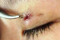 U hạt nhiễm khuẩn sau nhấn mí