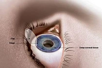 Lưu ý khi phẫu thuật cận thị