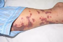 Vì sao viêm não mô cầu lại hay tấn công trẻ bụ bẫm, người khỏe mạnh?