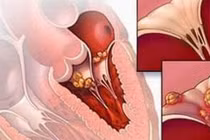 Điều trị bệnh thấp tim do khớp