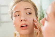 Chống da khô trong mùa lạnh