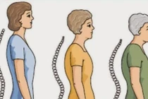 Tại sao phụ nữ sau mãn kinh lại thấp đi? 