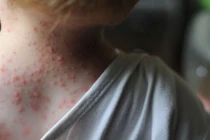 Việc xác nhận một ca mắc đậu mùa khỉ được xem là một ổ dịch