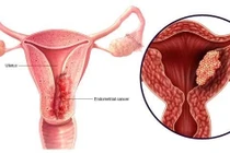 Ra máu ngoài kỳ kinh, cảnh giác ung thư nội mạc tử cung