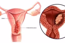 Ra máu ngoài kỳ kinh, cảnh giác ung thư nội mạc tử cung