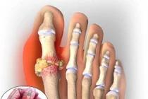 Chữa đau gút khi thời tiết chuyển mùa