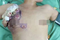 Khối u vú lở loét, bốc mùi vì không chịu đi khám
