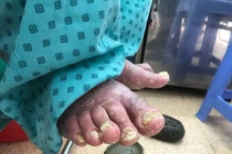 Cứng khớp, không đi lại được vì uống thuốc Nam trị vẩy nến