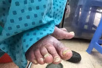 Cứng khớp, không đi lại được vì uống thuốc Nam trị vẩy nến